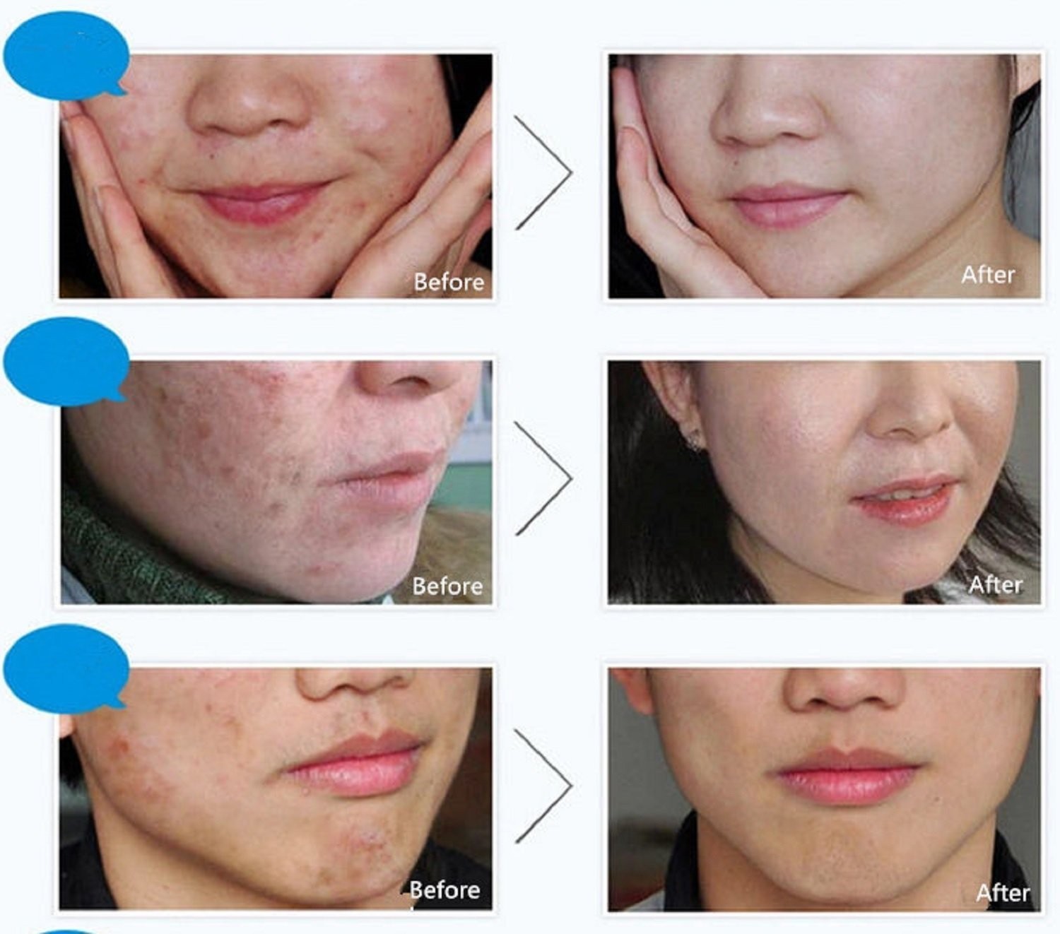 Bioaqua Acne Cream Scars Removal Face Cream
